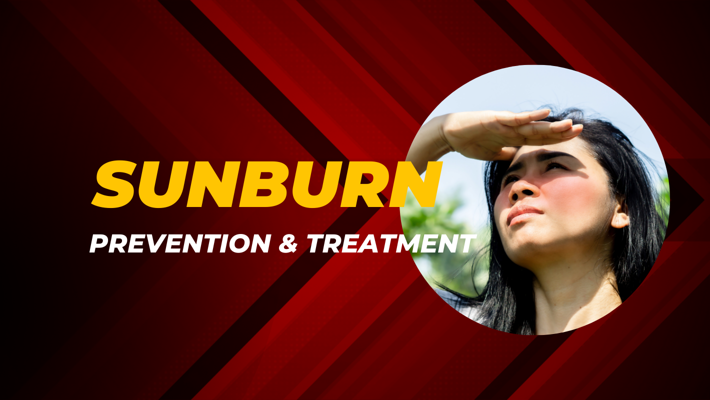 The Ultimate Guide to Understanding and Preventing Sunburn
